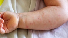 Atopic Dermatitis Linked to Increased IBD Risk in Adults and Kids ...