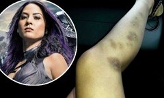 Olivia Munn shares photo of the bruises she got while filming X ...