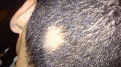 Scalp Conditions: , Causes, and Treatments