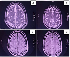 Cureus | Bipolar Disorder Due to Traumatic Brain Injury: A Case ...