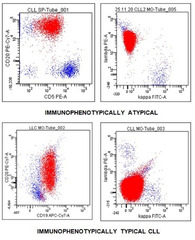 Cancers |-Text | What Does Atypical Chronic Lymphocytic ...