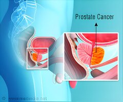 Immunotherapy Drug Boosts Prostate Cancer Treatment