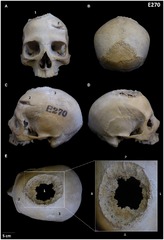 Frontiers | Case report: Boundaries of oncological and ...