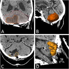 Frontiers | Clinical and Computerized Volumetric Analysis of ...