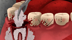 The Ultimate Guide to Dental Bone Grafting - Royal Dental Care