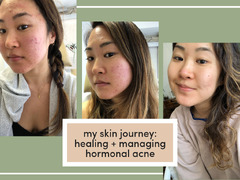 My Hormonal Acne Journey: Healing   Managing Acne — living minnaly